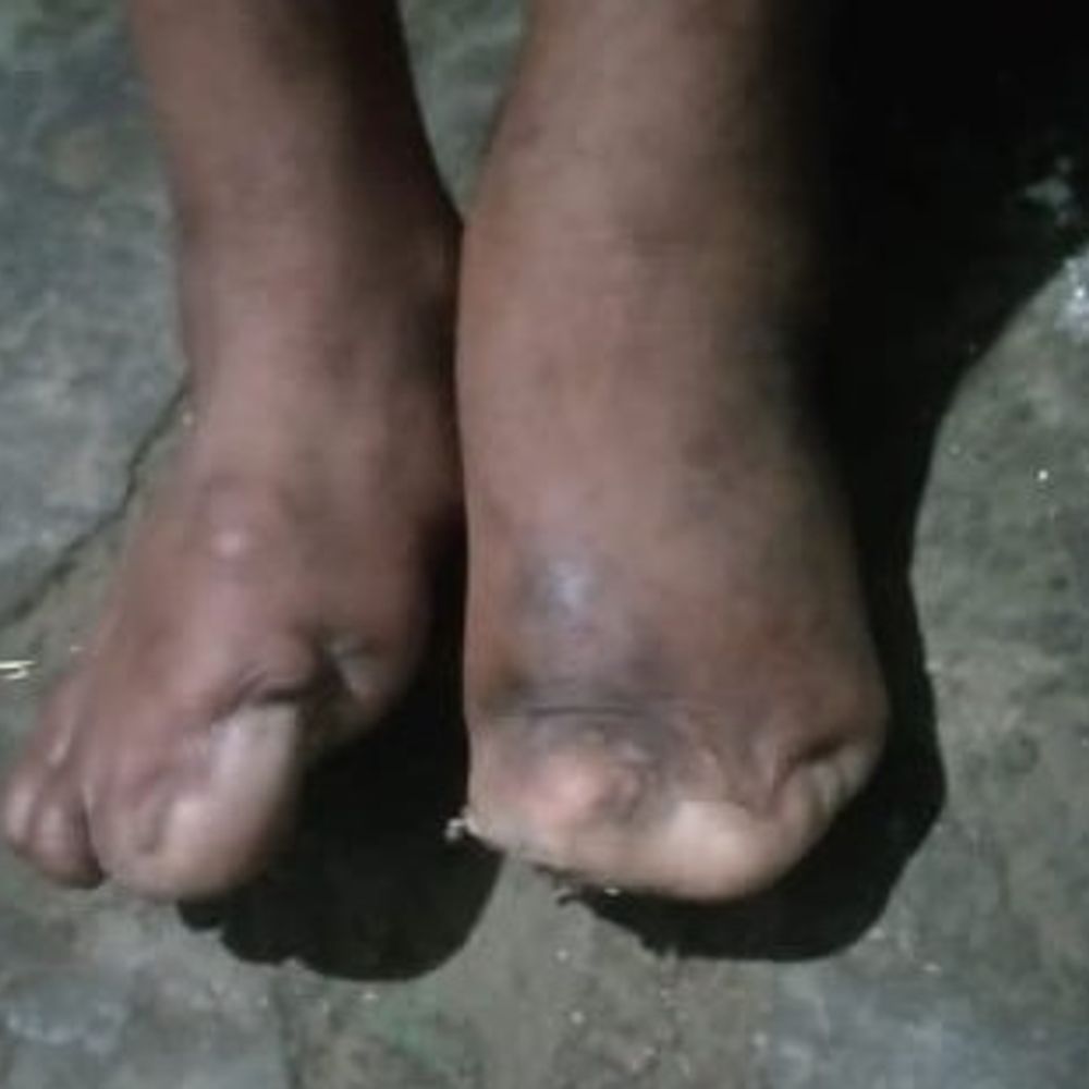 आगरा में चूहों ने कुतर डालीं पैरों की अंगुलियां:मां बोली- बेटी का कमर से नीचे का शरीर सुन्न रहता है,14 साल से झेल रही दर्द