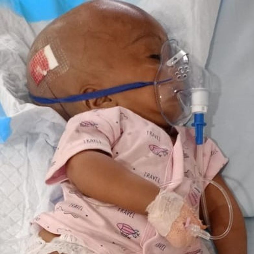 मासूम का हाइड्रोसिफैलस ऑपरेशन सफल:राष्ट्रीय बाल स्वास्थ्य कार्यक्रम के तहत राम मनोहर लोहिया में हुआ इलाज