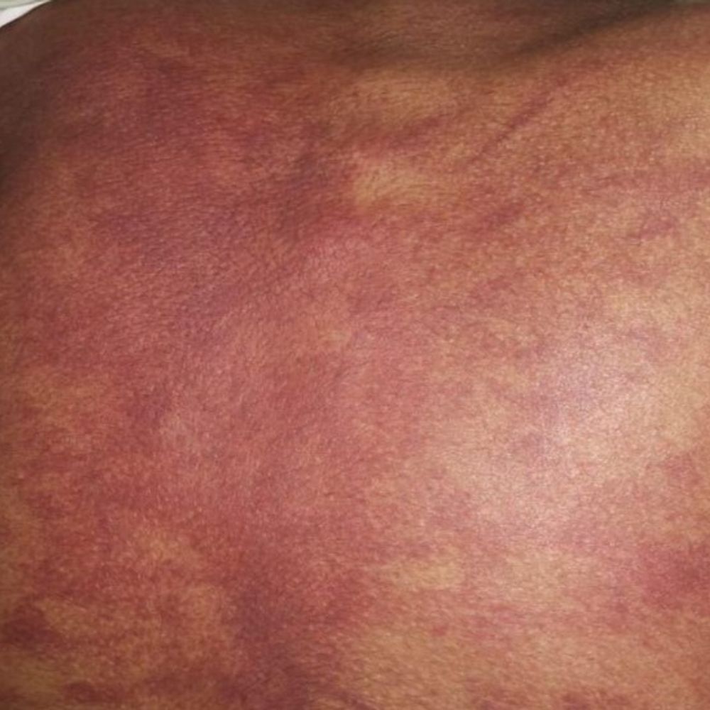 सुल्तानपुर में शिक्षक ने की छात्र की पिटाई:पीठ पर मिले निशान, स्कूल प्रबंधन ने शिक्षक को जारी किया कारण बताओ नोटिस