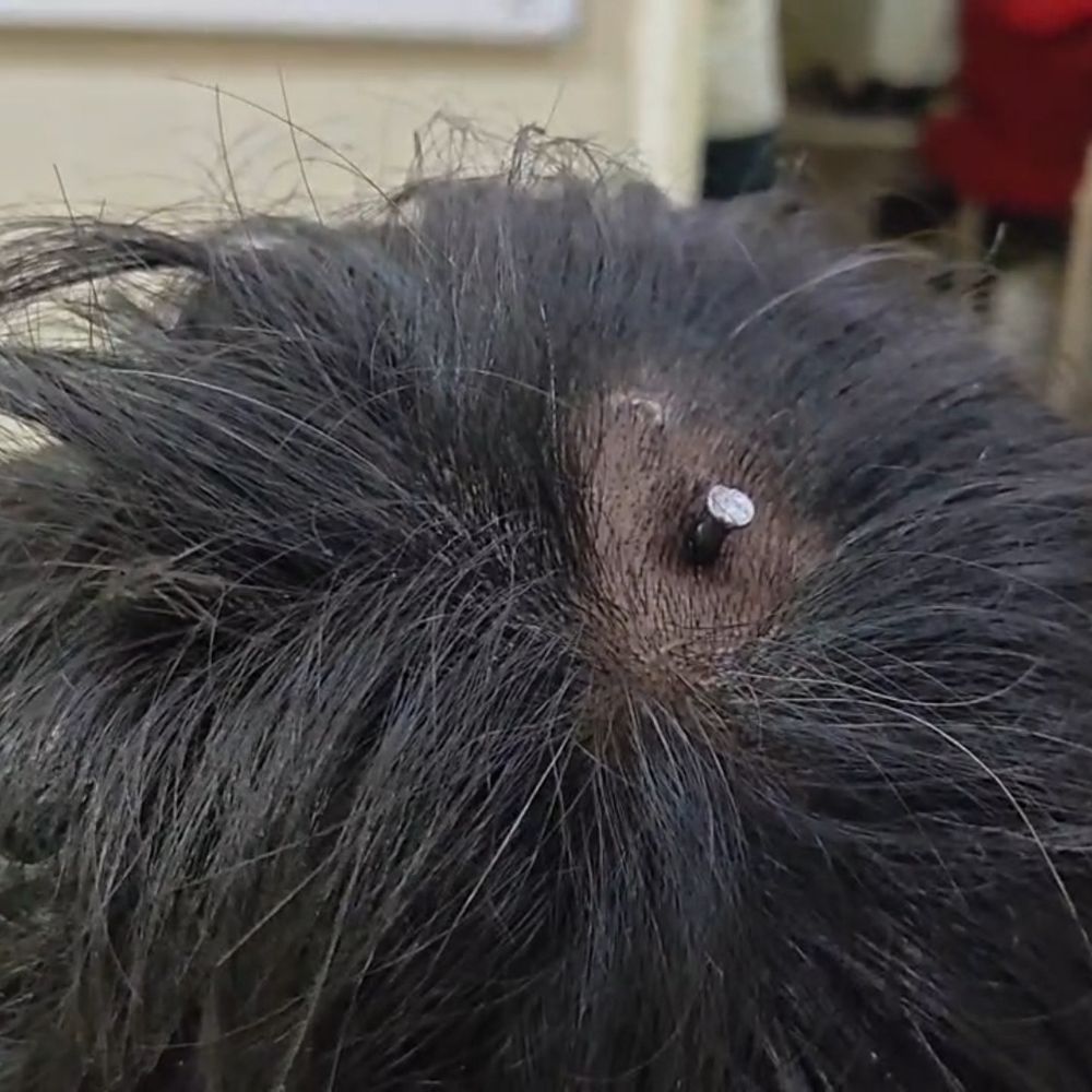 सिर में घुसी कील के साथ युवक पहुंचा एसएसपी ऑफिस:फिरोजाबाद में की शिकायत, मेडिकल न होने का भी आरोप