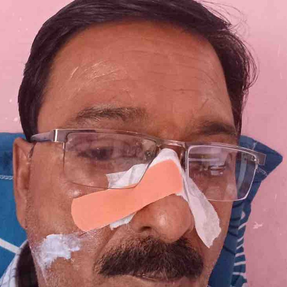 कानपुर में चाइनीज मांझे से फोटोग्राफर घायल:विधानसभा अध्यक्ष से मिलने जा रहा था, नाक में आई चोट