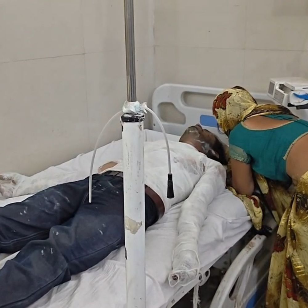 फिरोजाबाद में चूड़ी जुड़ाई के दौरान लैंप फटी:युवक गंभीर रूप से झुलसा, ट्रामा सेंटर में भर्ती