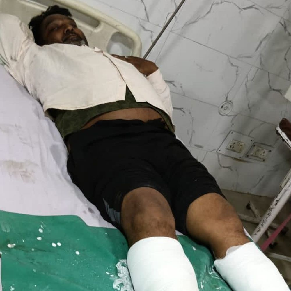 SC आयोग पहुंचा मजदूरों के हाथ-पैर तोड़ने का मामला:मुरादाबाद विकास प्राधिकरण के JE ने बरसाए थे डंडे, 5 जगह से टूटीं मजदूर की टांगें