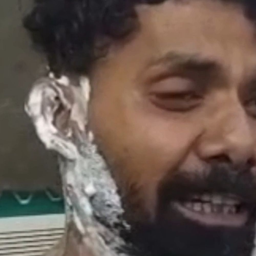 युवक के खुद को आग लगाने का मामला:पत्नी समेत ससुरालियों पर आत्महत्या के लिए उकसाने का केस दर्ज, 04 फरवरी की रात हुई थी घटना