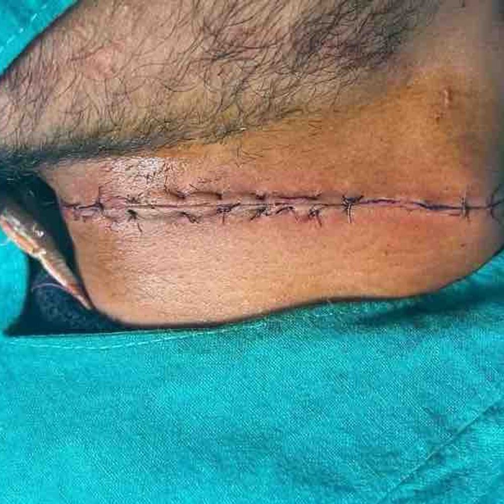 चाइनीज मांझे से युवक की गर्दन कटी, गंभीर:गले में टांके लगे, रोक के बावजूद कानपुर में बिक्री हो रही