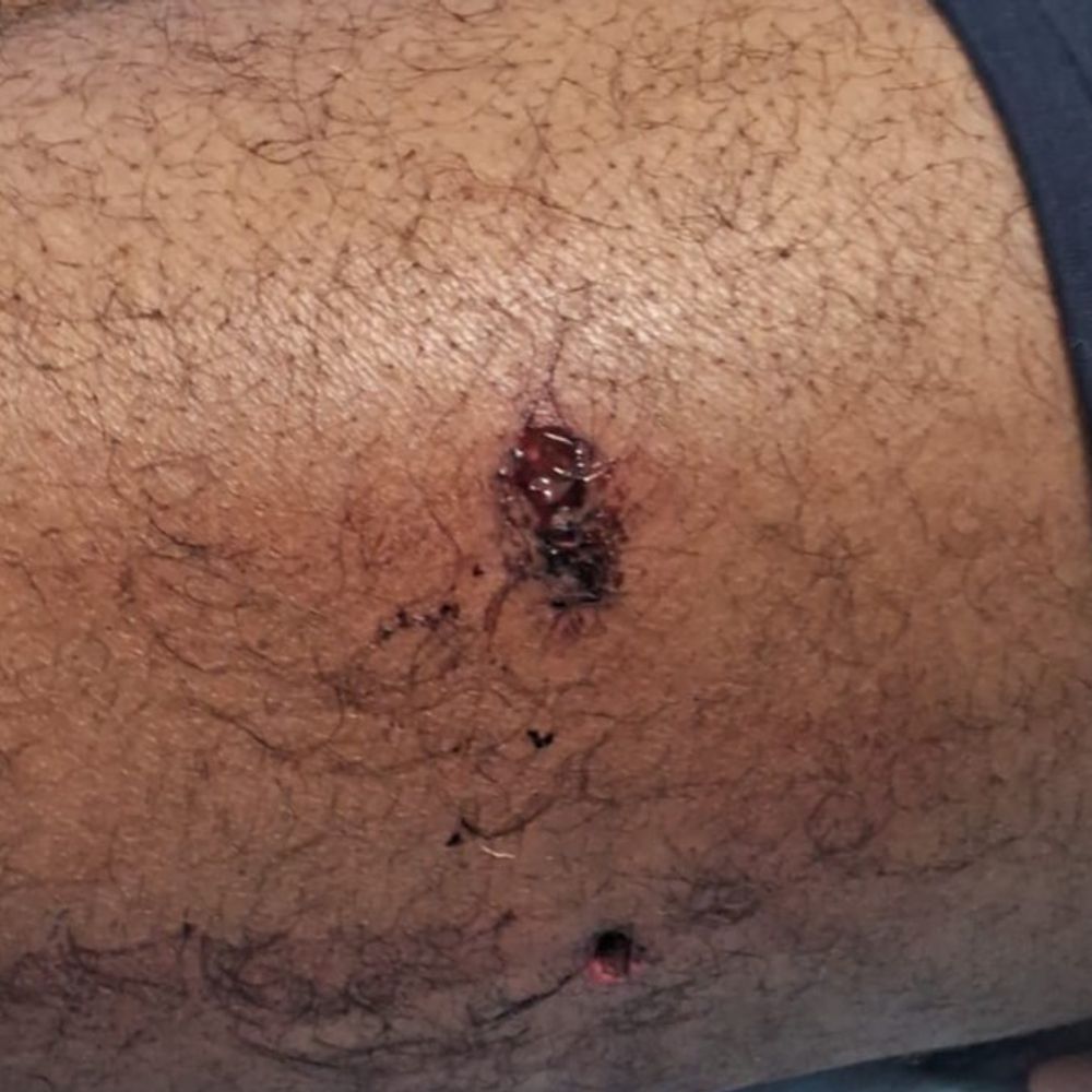 पुरानी रंजिश में युवक पर फायरिंग:पांच आरोपियों ने किया हमला, एक गिरफ्तार अन्य की तलाश जारी