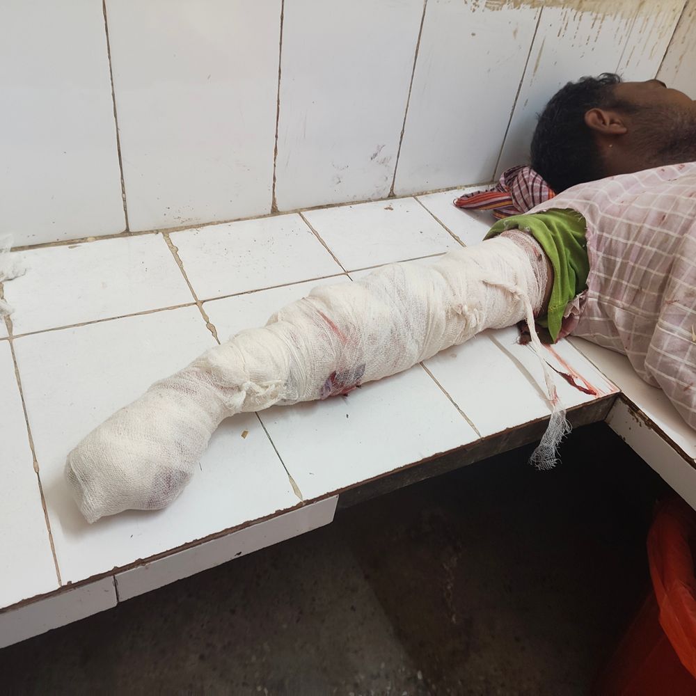 खड्डा में चारा मशीन में फंसकर मजदूर का हाथ कटा:दाहिने हाथ की पांचों उंगलियां कटी, बेहोश होकर जमीन पर गिरे