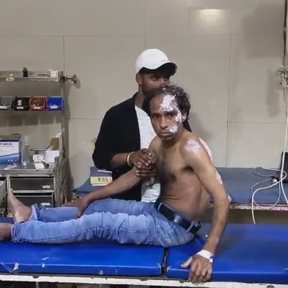 फिरोजाबाद में चूड़ी फैक्ट्री में मजदूर झुलसा:मालिक पर इलाज न कराने का आरोप, ट्रॉमा सेंटर में भर्ती