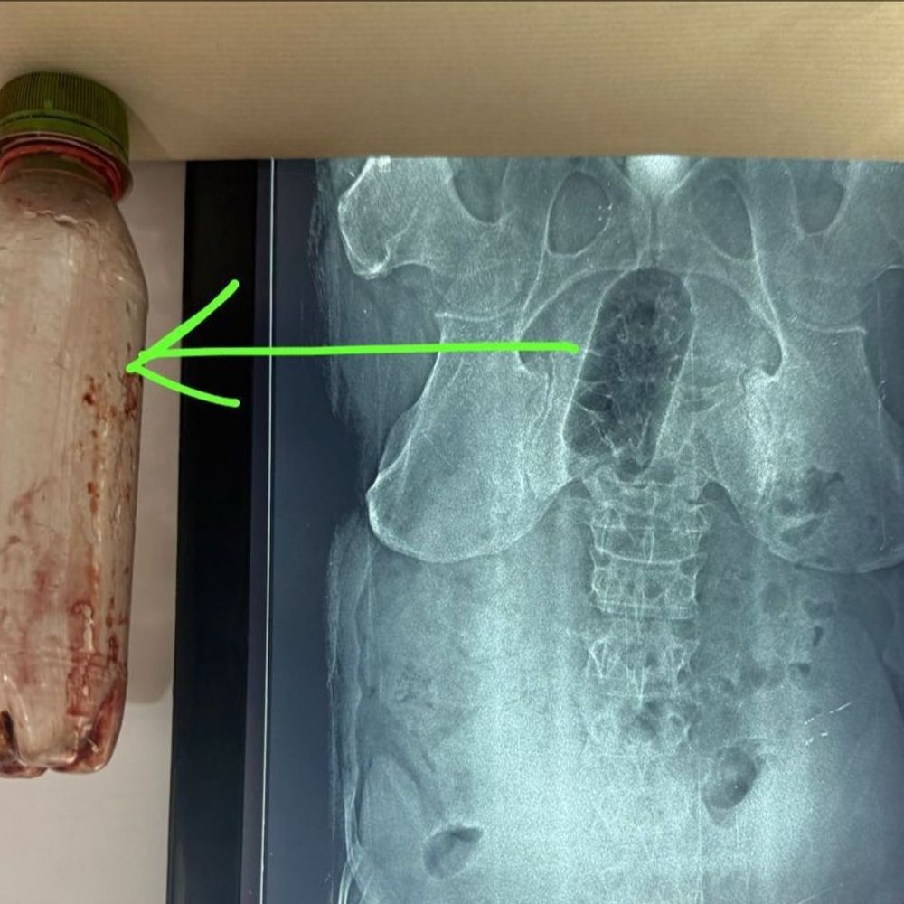 युवक के मलाशय में फंसी बोतल, 36-घंटे बाद आपरेशन:साइको सेक्सुअल डिसआर्डर एनल से पीड़ित है युवक