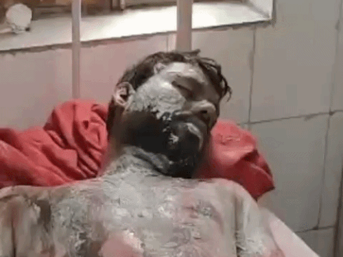 गैस खुली रह गई, माचिस जलाते ही आग का गोला:  करीब 85 से 90 प्रतिशत झुलसा चिनाई मिस्त्री, दूध गर्म करते समय हुई चूक – Alwar News