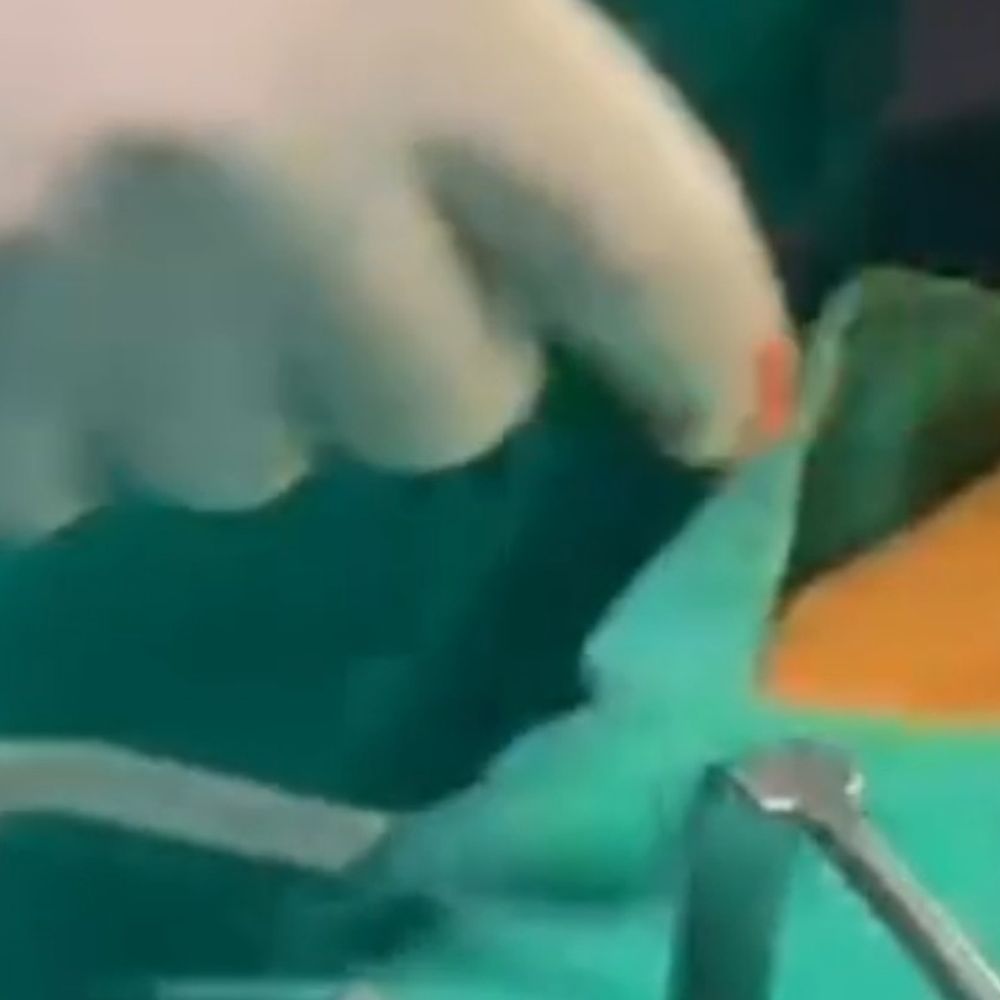 अंबेडकरनगर में युवक के मलाशय में फंसी प्लास्टिक बोतल:दो घंटे की सर्जरी कर डॉक्टरों ने बचाई जान, हालत खतरे से बाहर