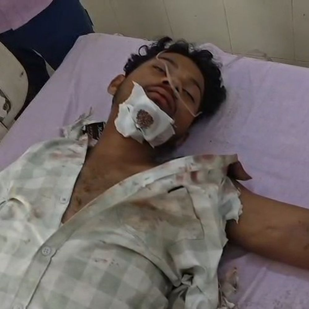 आकाशीय बिजली गिरने से दो मजदूर घायल:उन्नाव में सड़क निर्माण के दौरान हादसा, अस्पताल में भर्ती