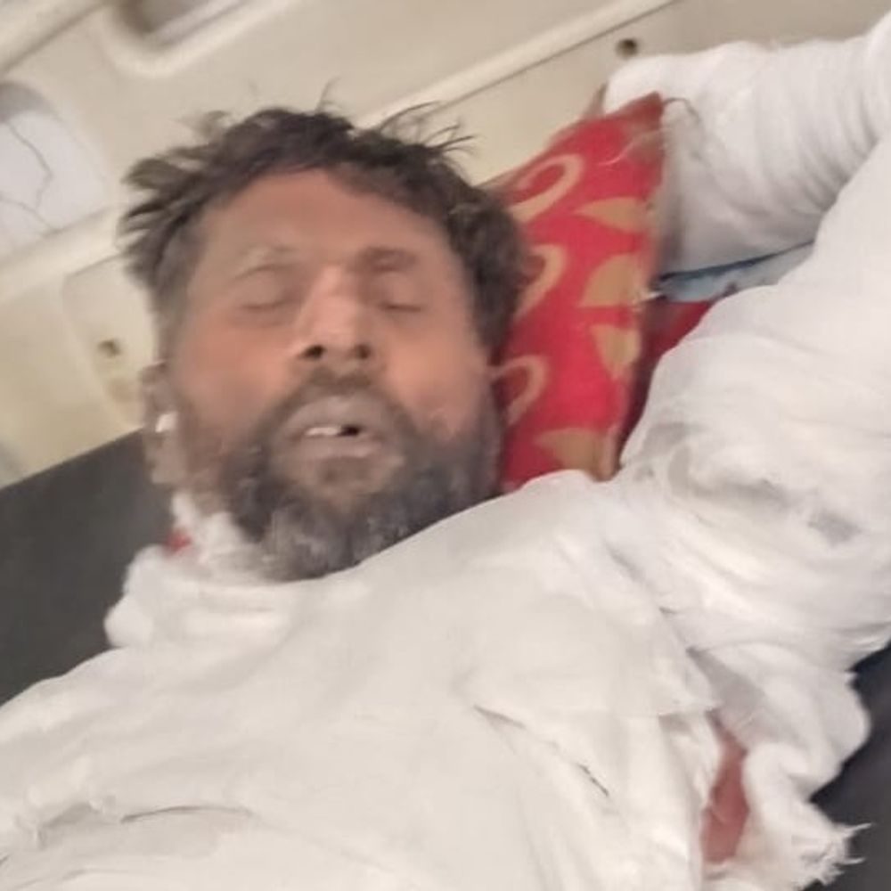 संभल में भाई को सोते समय आग लगाई, 80% झुलसा:ट्रैक्टर खड़ा करने को लेकर हुआ था विवाद, आरोपी बड़ा भाई गिरफ्तार