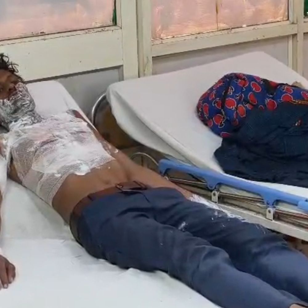 भाई से विवाद में युवक ने खुद को लगाई आग:बचाने आई मां भी झुलसी, गंभीर हालत में अस्पताल में भर्ती