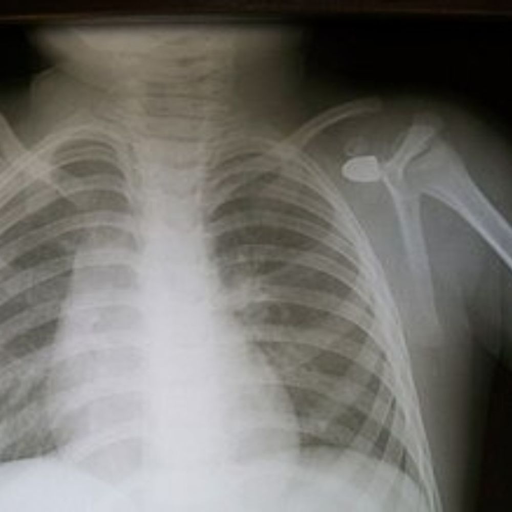 ग्वालियर में संदिग्ध हालात में महिला को लगी गोली:  घर की सफाई करते समय कंधे में लगी गोली, सीटी स्कैन में पता लगा – Gwalior News