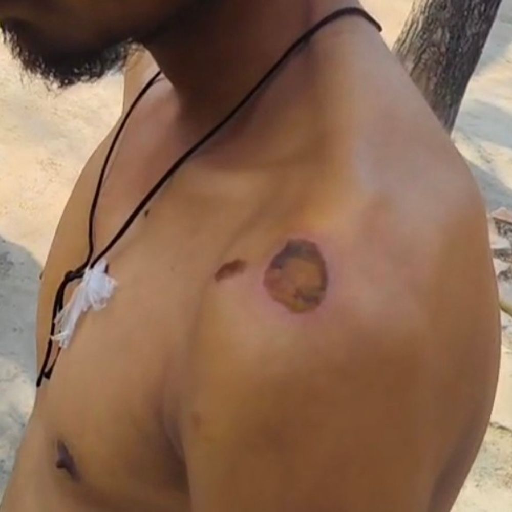 प्राइवेट बिजलीकर्मी पर मारपीट का आरोप झूठा:पुलिस जांच में दावा निकला गलत, गिरने से लगी थी चोट