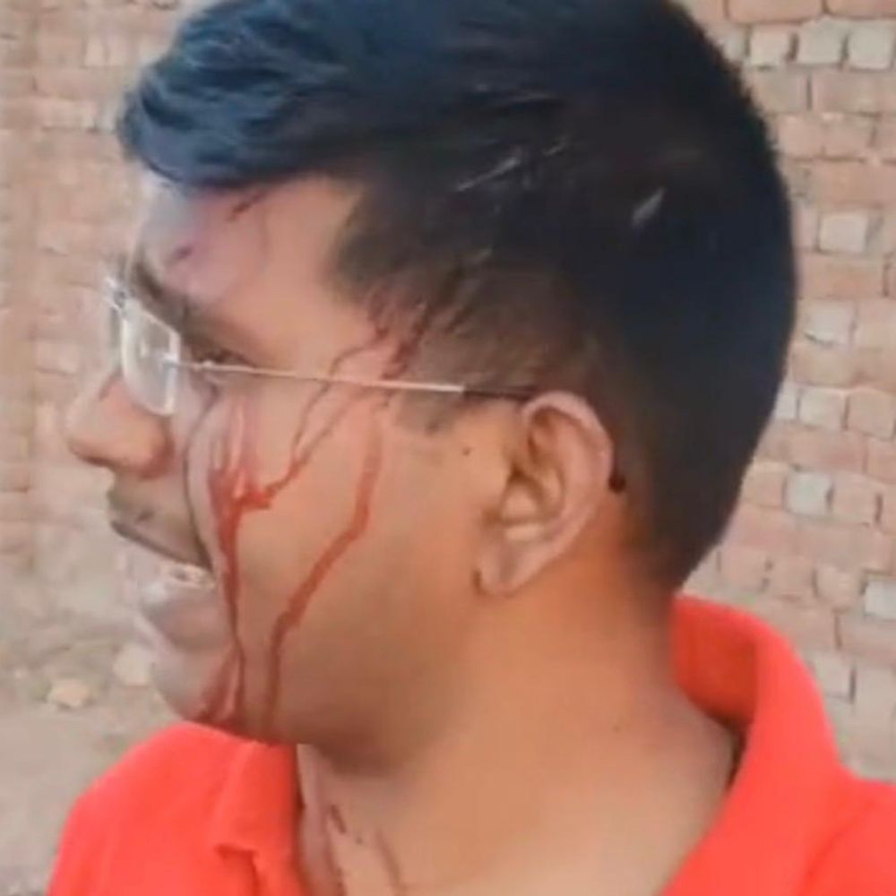 आंबेडकर यूनिवर्सिटी के कैंपस में छात्र संग मारपीट:लहुलुहान हुए छात्र का वीडियो सोशल मीडिया पर वायरल, कुलपति ने दिए डिबार के आदेश