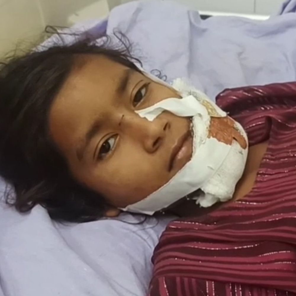 बहराइच में कुत्ते ने बच्ची पर किया हमला:चेहरे पर घाव के गहरे निशान, जिला अस्पताल में इलाज जारी