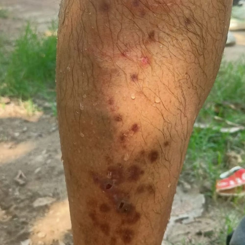 पोस्टमार्टम हाउस के बाहर कुत्ते ने आठ को काटा:बड़ा इमामबाड़े के बाहर भी चार पर्यटक बने शिकार, दहशत में लोग