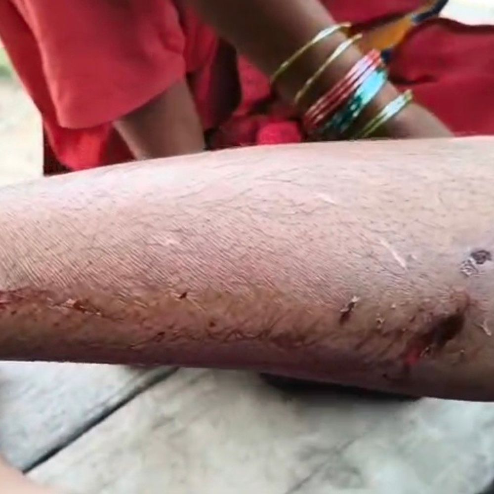 रायबरेली में सियार के हमले से युवती घायल:सुबह शौच के लिए खेत गई थी, पैर में गंभीर घाव, 4 अन्य बाल-बाल बचे