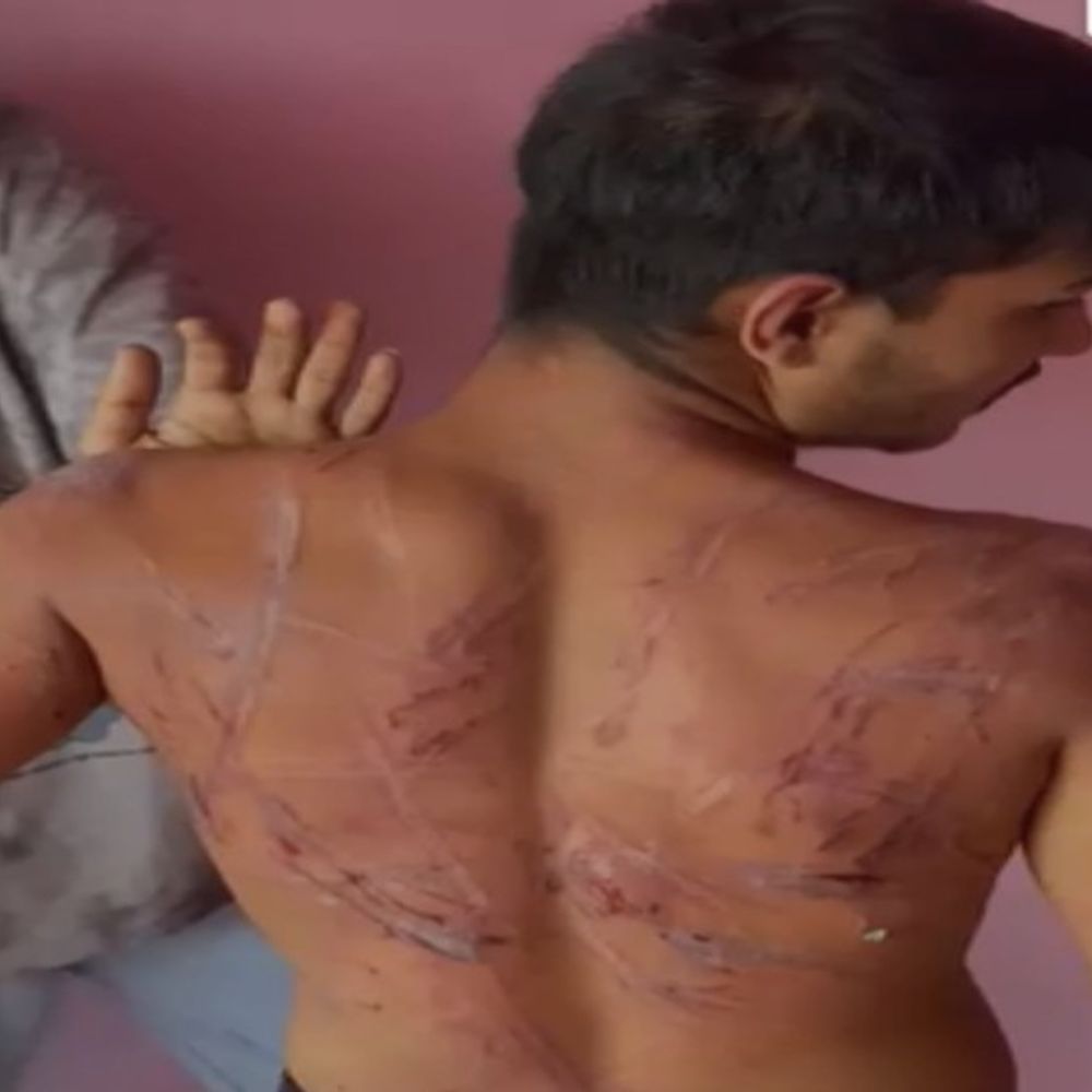 रायपुर नशामुक्ति केंद्र में आदिवासी युवक से बर्बरता…VIDEO:  नशे का लत छुडाने परिजनों ने कराया था भर्ती, केंद्र संचालक के बेटे ने इतना पीटा कि मानसिक संतुलन खो बैठा; पीठ-गर्दन की खाल छिली – Raipur News