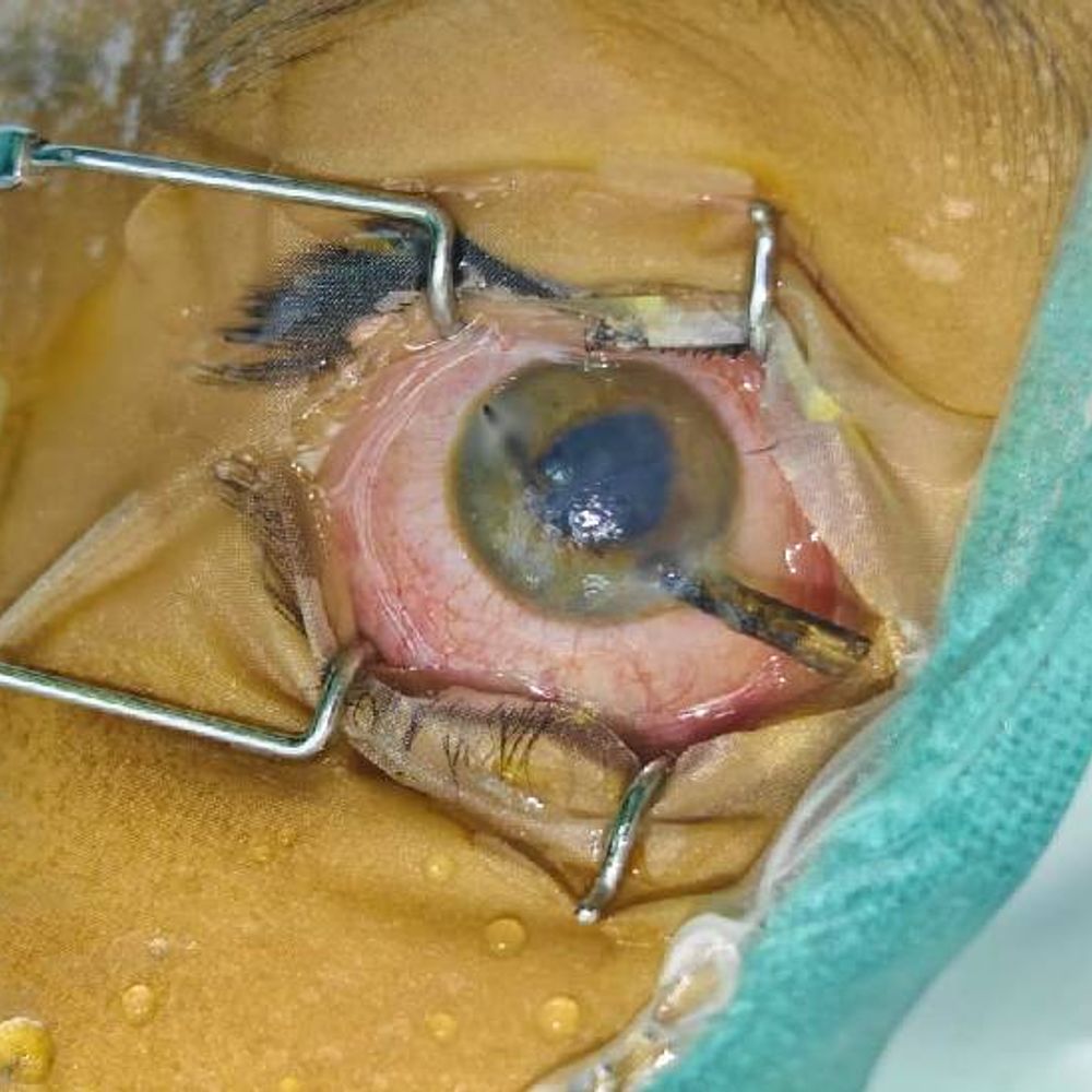 7 साल के बच्चे की आंख में घुसा कांटा:झांसी में पुतली में आर-पार हुआ, मेडिकल कॉलेज के डॉक्टरों ने OT खुलवाकर सर्जरी की