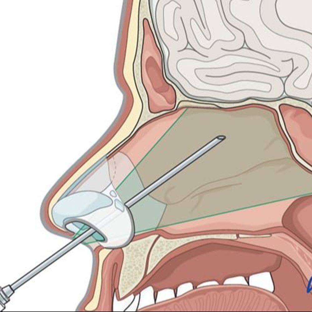 एसएन मेडिकल कॉलेज में बिना चीरे अस्थि दोष किया रिपेयर:डॉक्टर बोले- विभाग भविष्य में भी ऐसी सभी जटिल सर्जरी करने के लिए पूरी तरह तैयार