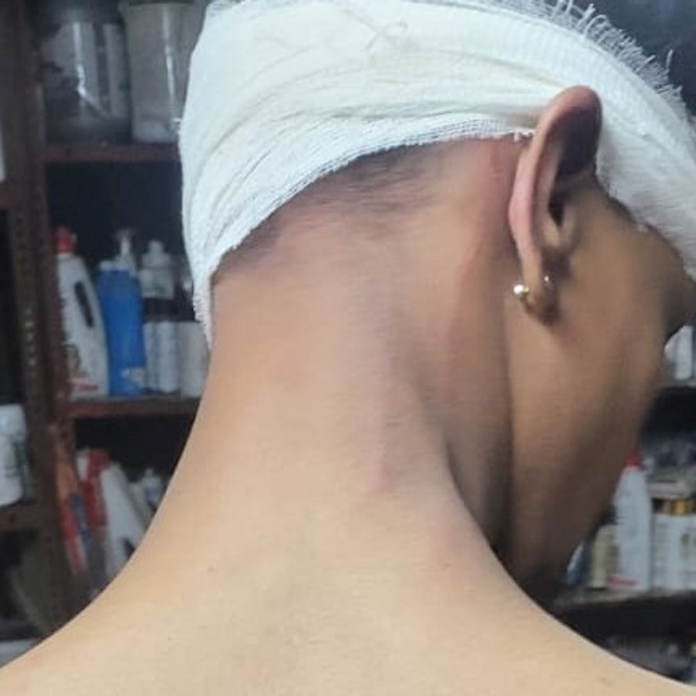 लखनऊ में कैफे में बैठने को लेकर मारपीट:दबंगों ने किया धारदार हथियार से हमला, युवक का कान कटा