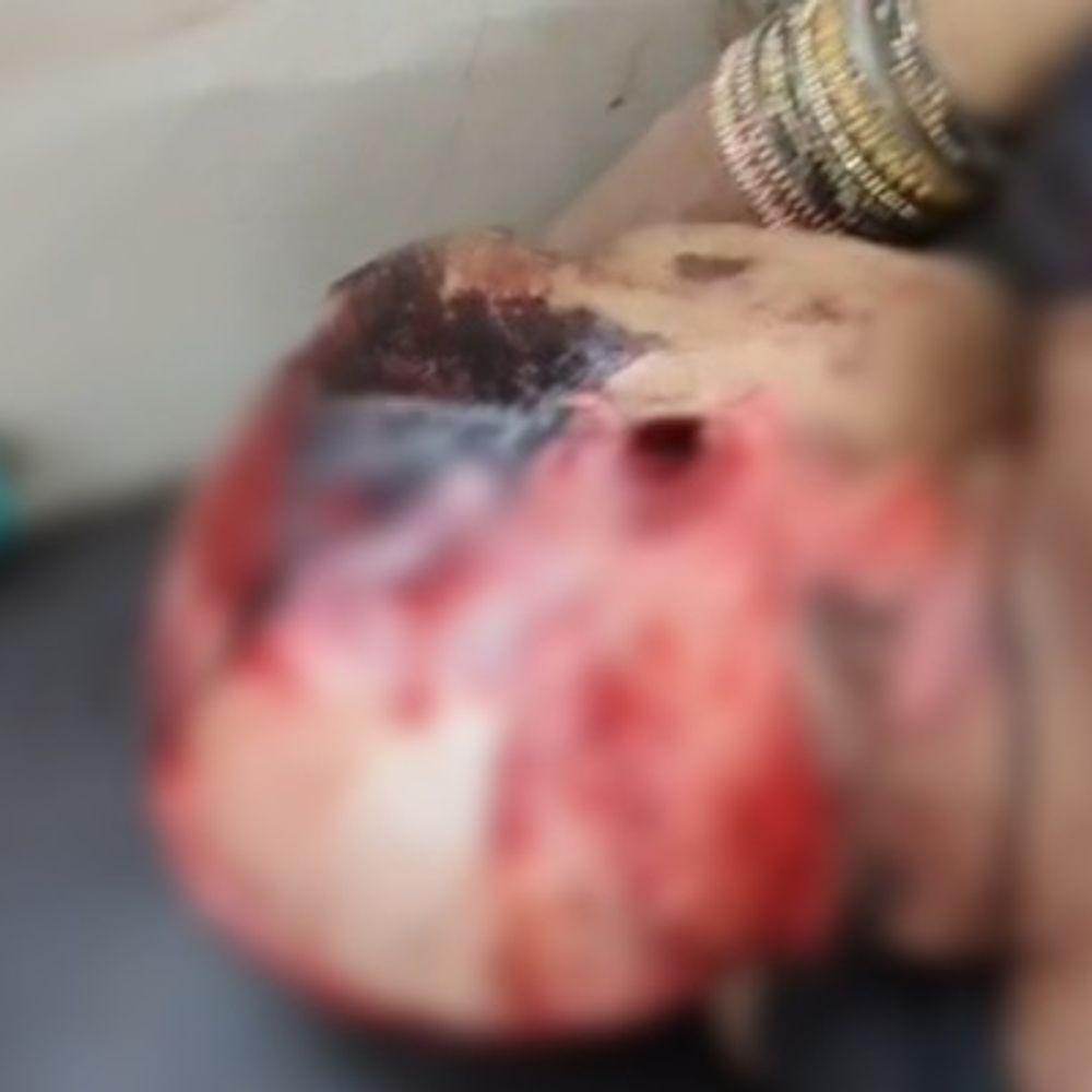 बहराइच में थ्रेसर मशीन में फंसा दुपट्टा:महिला गंभीर रूप से घायल, लखनऊ रेफर