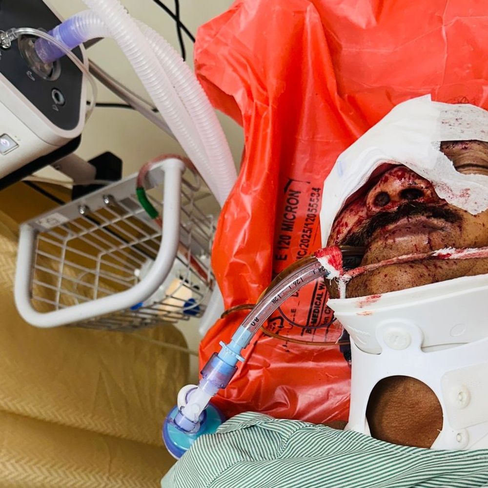 ग्रेटर नोएडा में बुजुर्ग को गोली मारने वाला गिरफ्तार:रंजिश में की थी वारदात, मुठभेड़ में पैर में लगी गोली