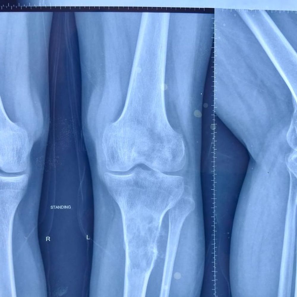 एम्स पटना ने कैंसर पीड़ित युवक का पैर बचाया:दुर्लभ ईविंग सारकोमा में 'लिंब सेवेज' तकनीक से बचाया, पटना AIIMS का पहला केस