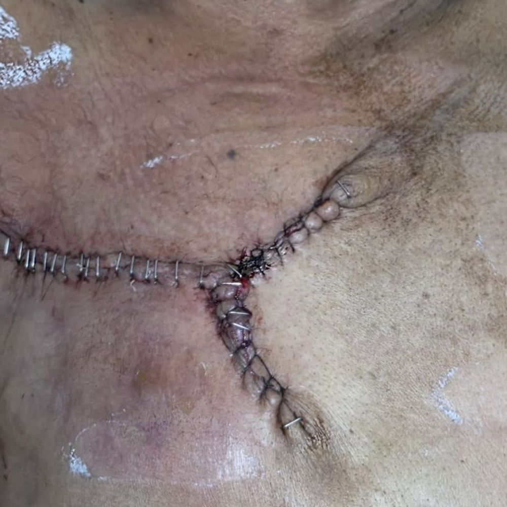 15 साल पुराना 3 किलो ट्यूमर निकाला:लकवाग्रस्त मरीज का दो घंटे चला ऑपरेशन, मेडिकल कॉलेज में हुआ ऑपरेशन