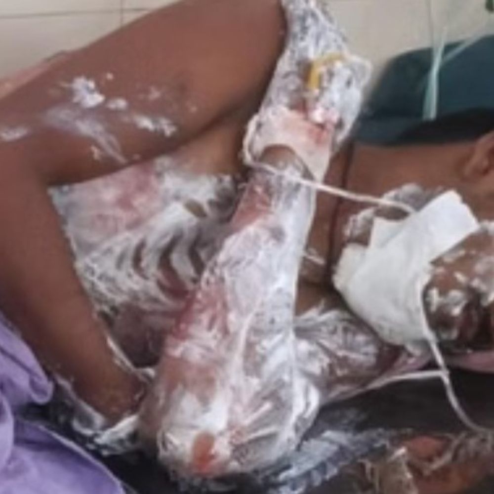 बहराइच में चलती बाइक में लगी आग:युवक गंभीर रूप से झुलसा, रिश्तेदार के घर जाते समय हादसा, लखनऊ रेफर