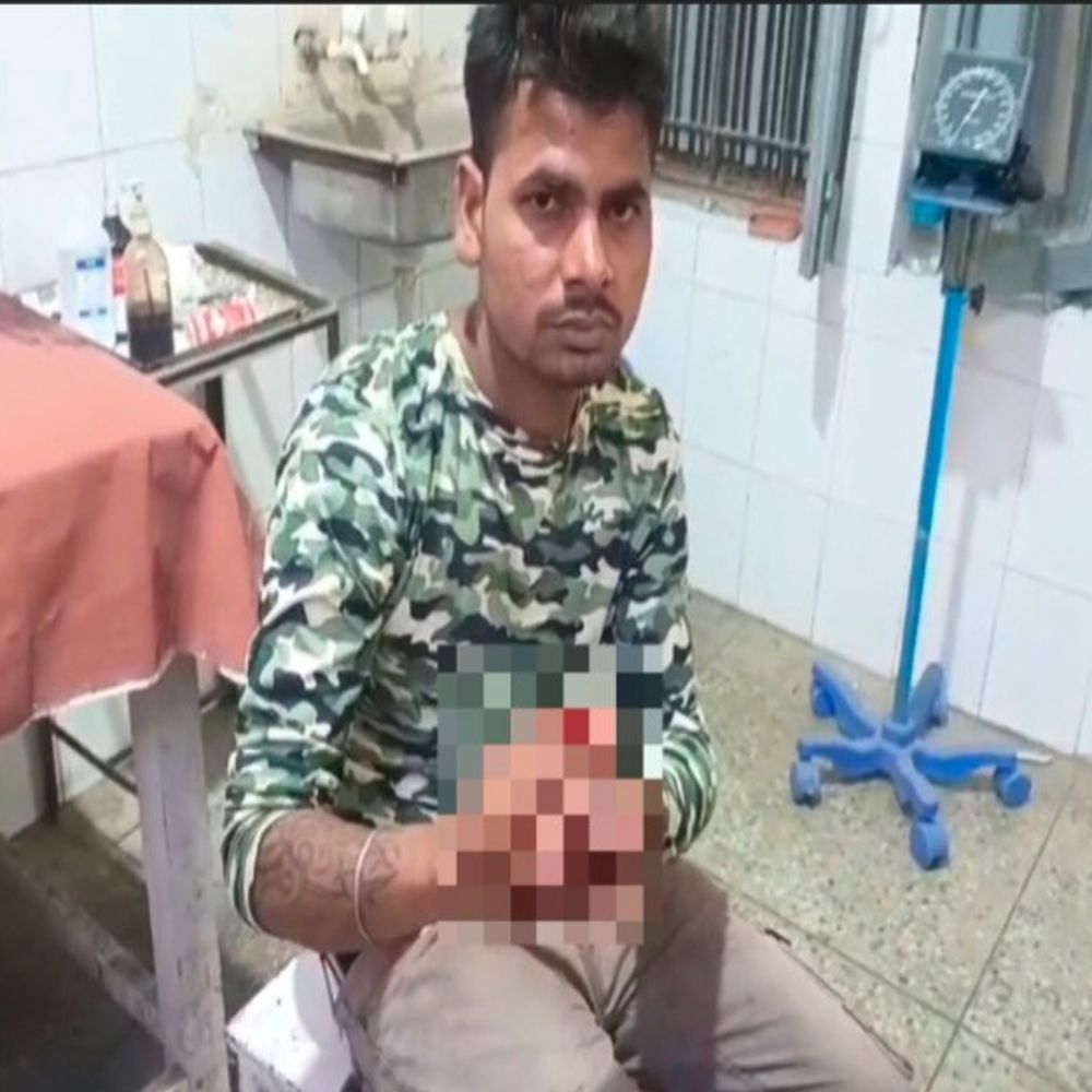 भतीजे ने चाचा की उंगली चबाकर अलग की:पत्नी को पीट रहा था युवक, बचाने पर कर दिया था हमला