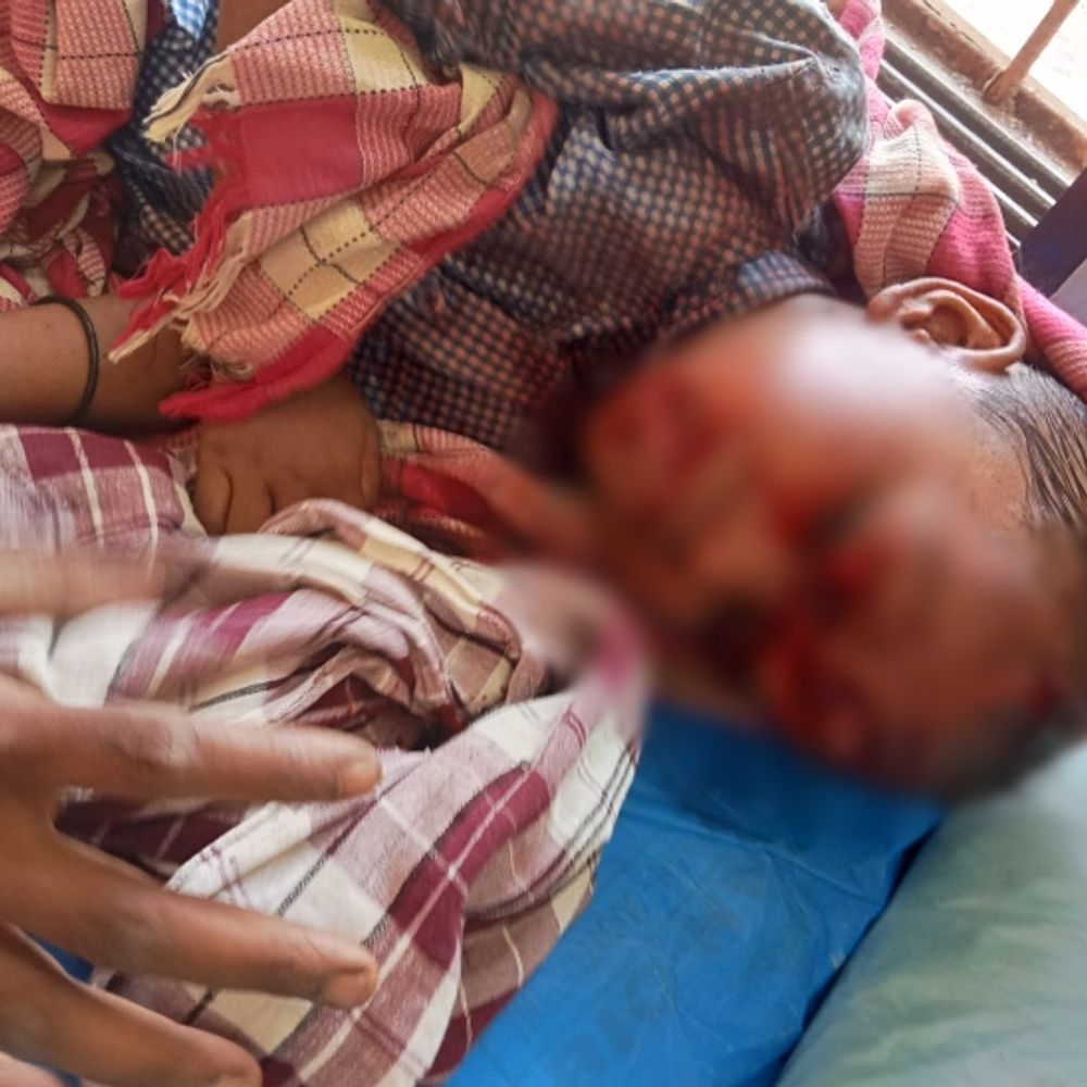 4 साल के बच्चे को कुत्ते ने दौड़ा-दौड़ाकर काटा:  हालत गंभीर, सिर-मुंह समेत 17 जगहों पर गहरे जख्म के निशान; घर के पास खेल रहा था – Balod News