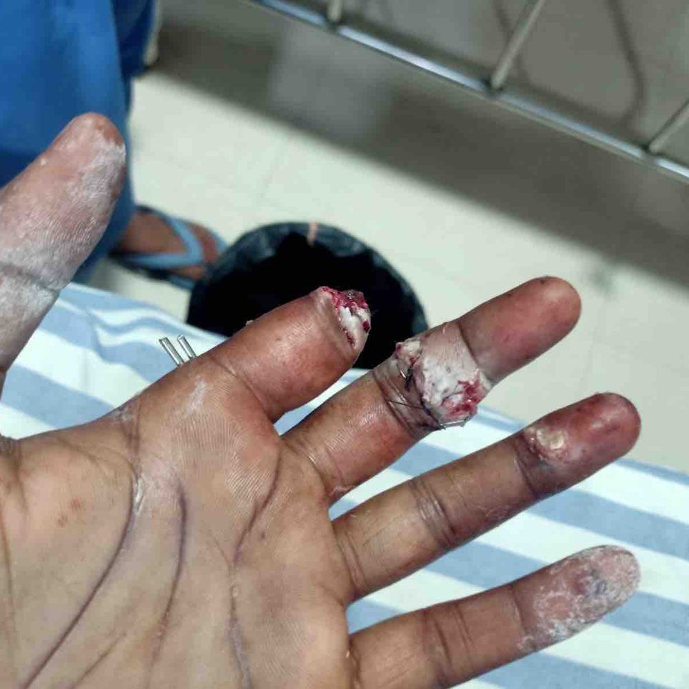 कानपुर में पुरानी रंजिश पर ईंट से हमला:कचरा फेकने से टोका तो हमला किया, एक उंगली कटी, 3 टूटी; FIR दर्ज