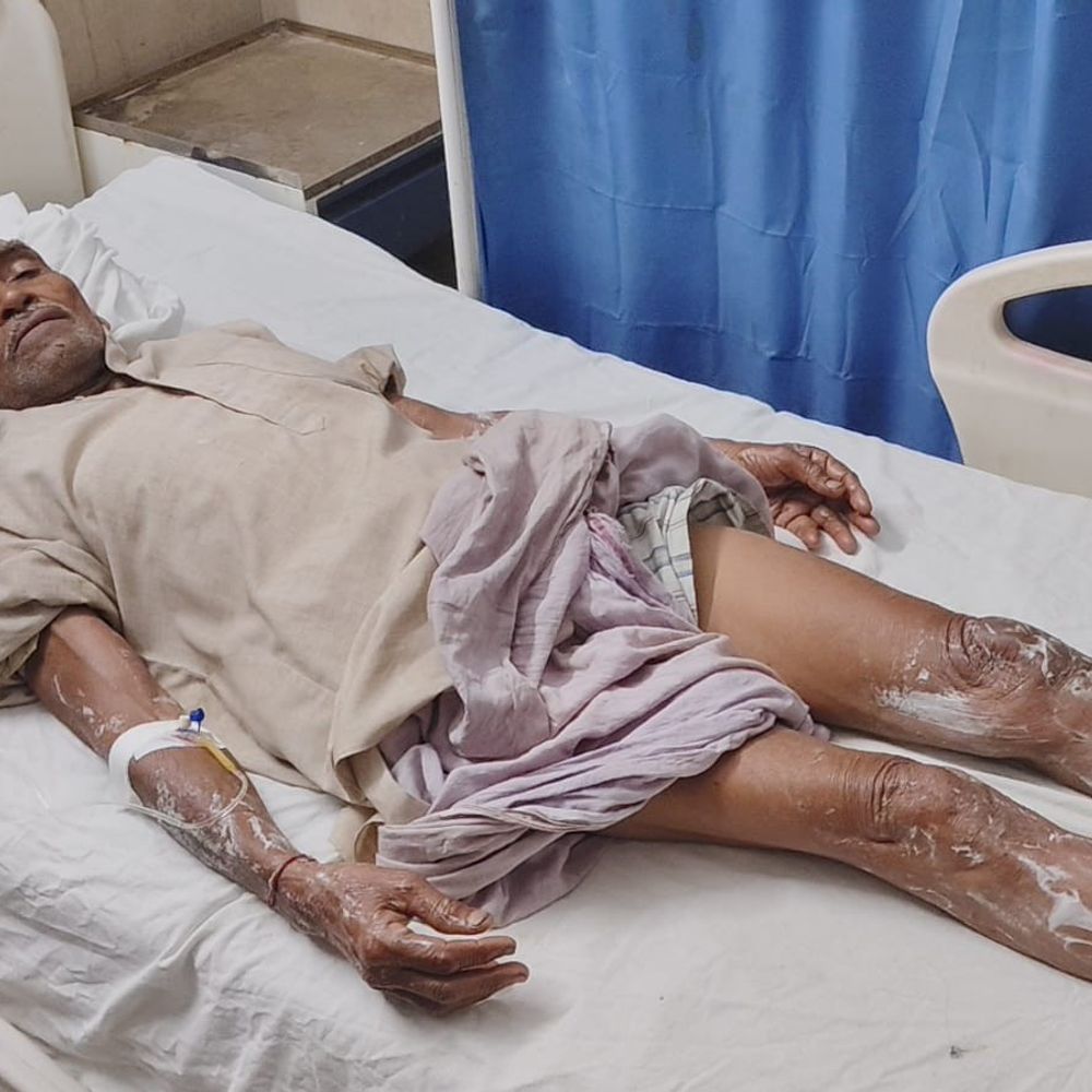 बहराइच में कूड़ा जलाते समय बुजुर्ग झुलसा:तेज लपटों से कपड़े में लगी आग, अस्पताल में भर्ती