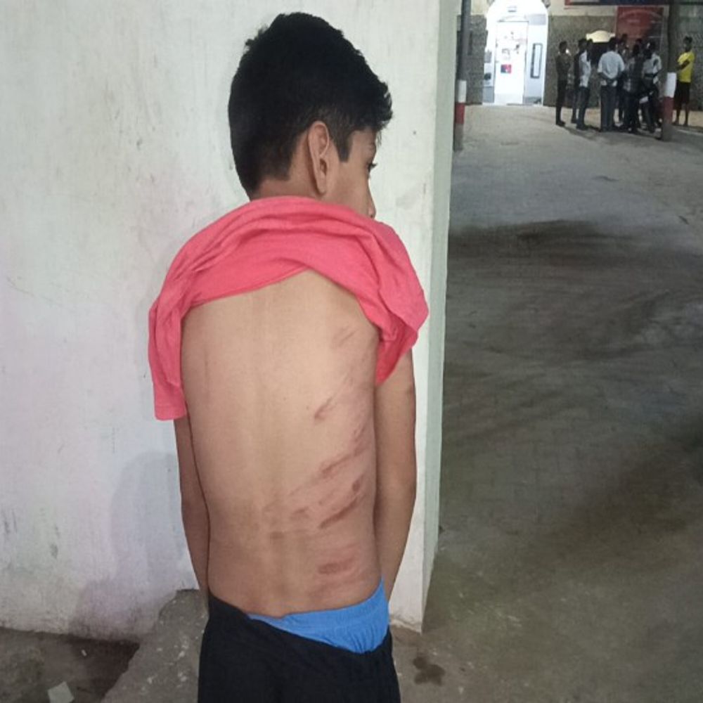 पहाड़ा न सुनाने पर छात्र को बेरहमी से पीटा:बच्चे की पीठ पर जख्म, पिता बोले- 4 दिन से ट्यूशन पढ़ा रहा था
