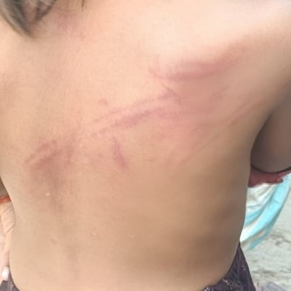 टीचर पर बच्ची को पीटने का आरोप, पीठ पर निशान:स्कूल देर से पहुंचने पर डंडे से मारा, परिजनों ने पुलिस में की शिकायत