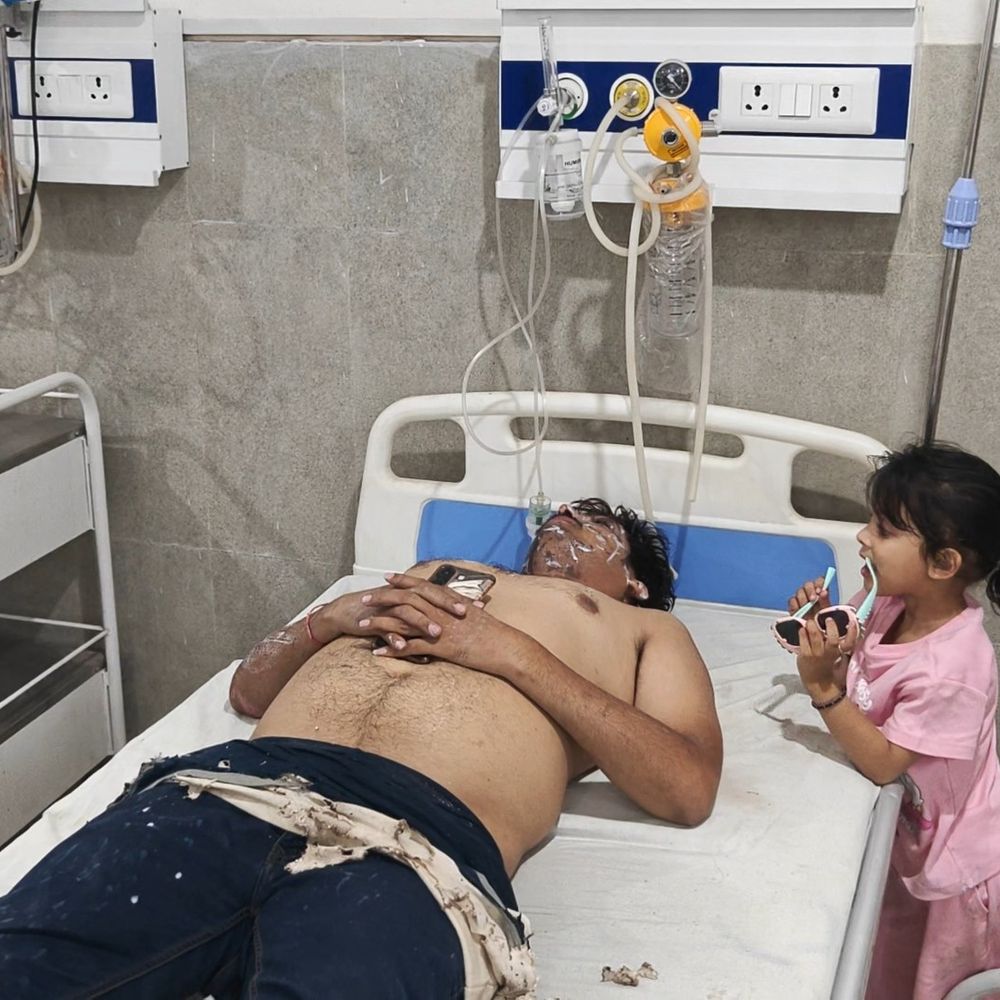 पीलीभीत में पत्नी ने पति पर तेजाब फेंका:पत्नी पर अवैध संबंध और दहेज उत्पीड़न का लगाया है आरोप, जांच में जुटी पुलिस