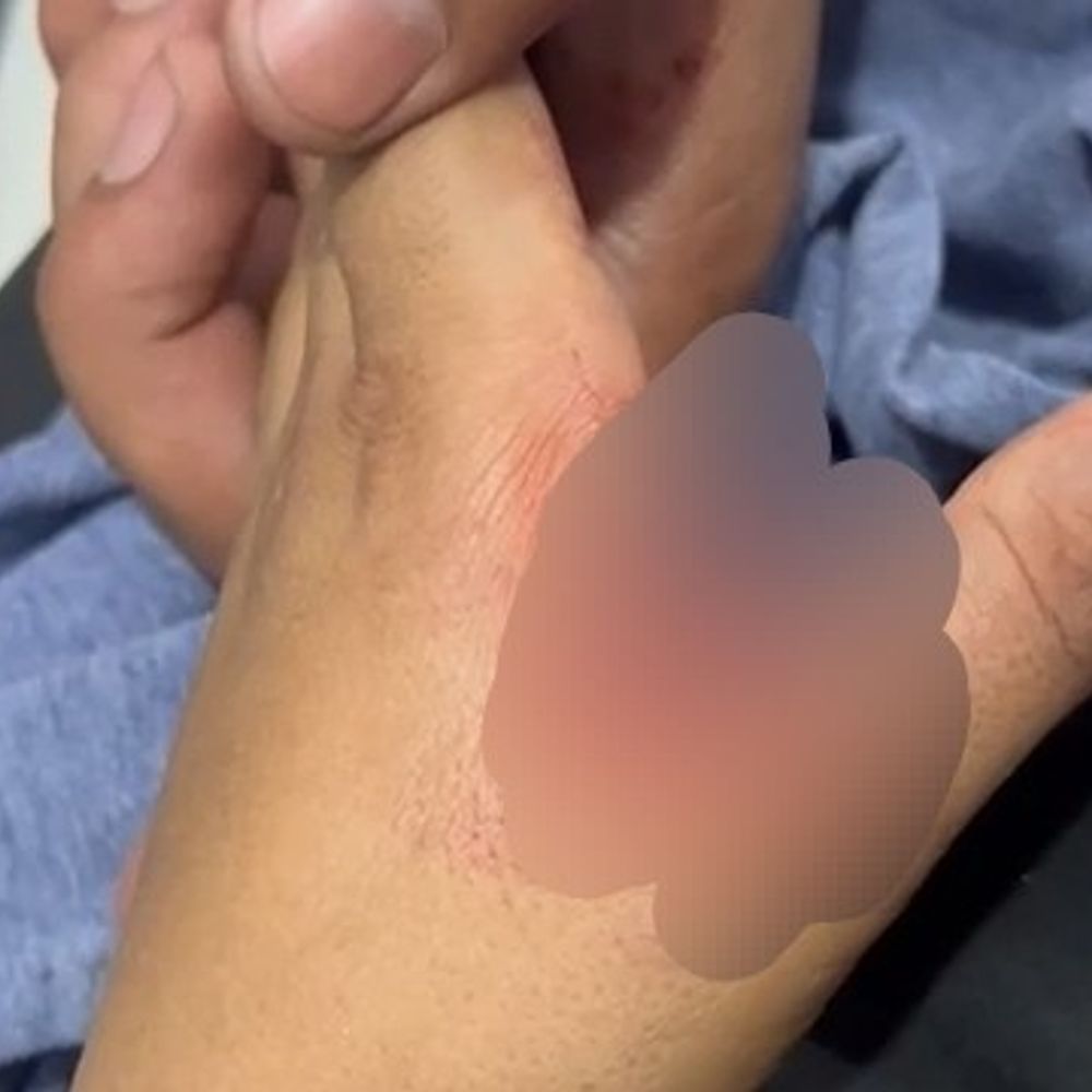 अमरोहा में कुत्ते ने दो बच्चों पर हमला किया:घर के बाहर खेलते समय काटा, स्थानीय लोगों ने छुड़ाया, गंभीर हालत में भर्ती