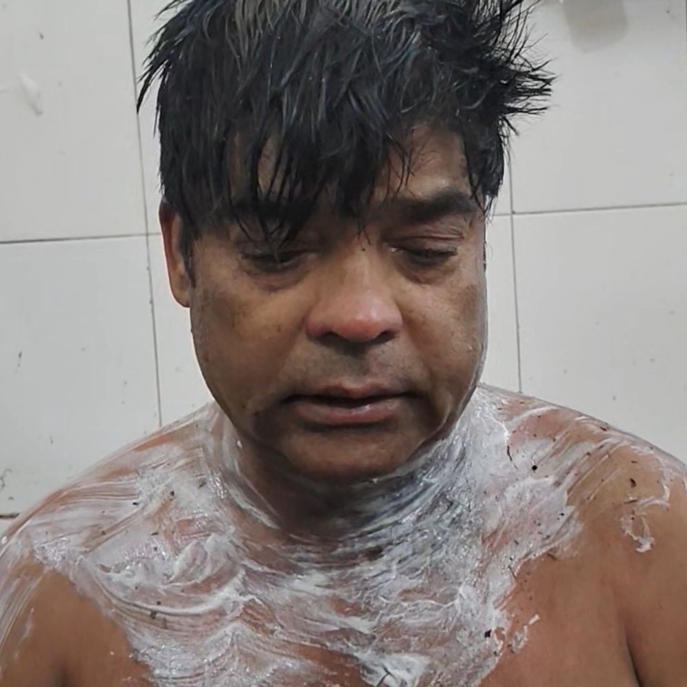 चलती बाइक पर पूर्व प्रधान को पेट्रोल डालकर आग लगाई:कीचड़ में कूदकर बचाई जान, सीतापुर में मृत्यु प्रमाण पत्र न बनाने से नाराज था