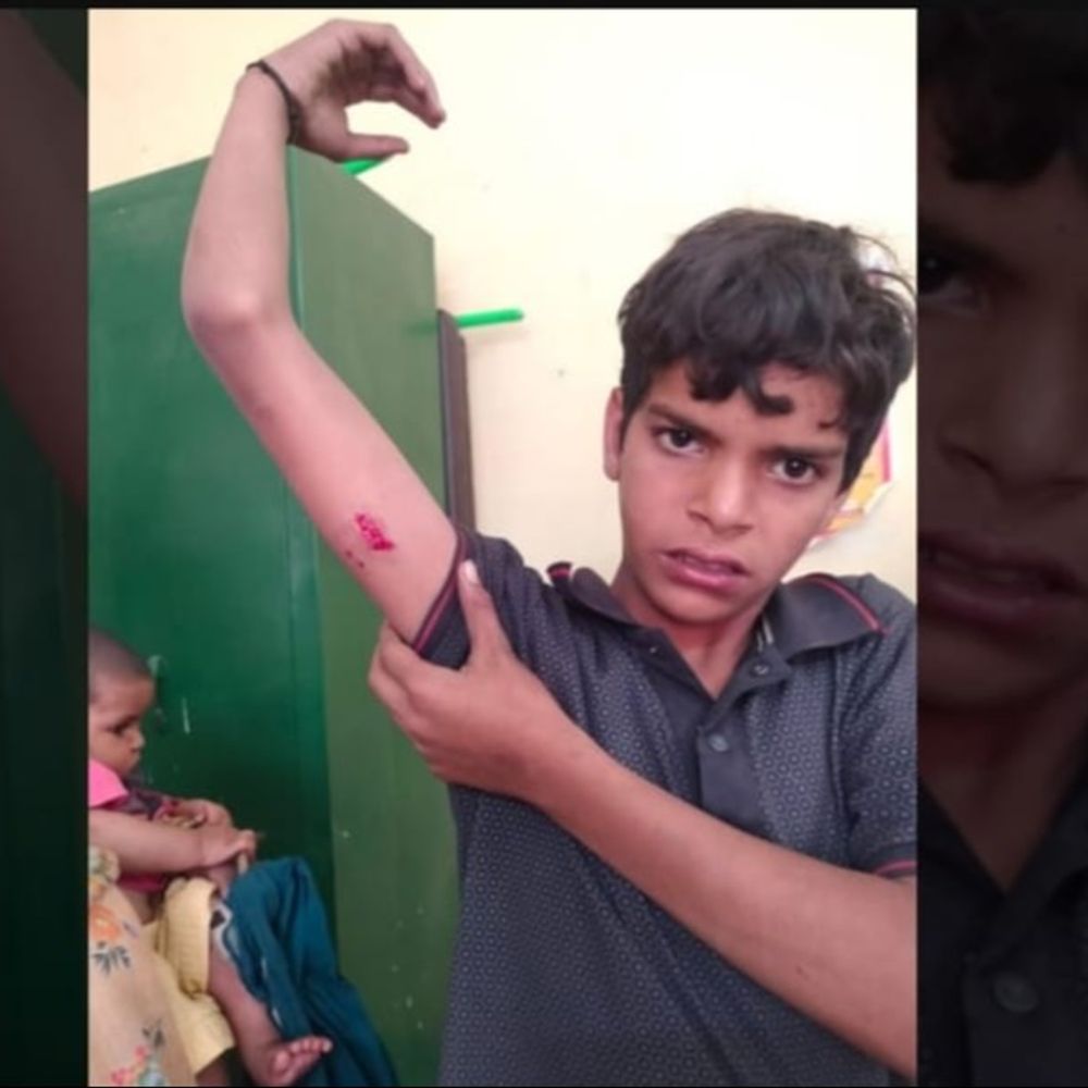 घर के बाहर खेल रहे भाइयों को कुत्ते ने काटा:लोगों ने लाठी-डंडों से बचाया ,लावड़ की बंजारा बस्ती की घटना