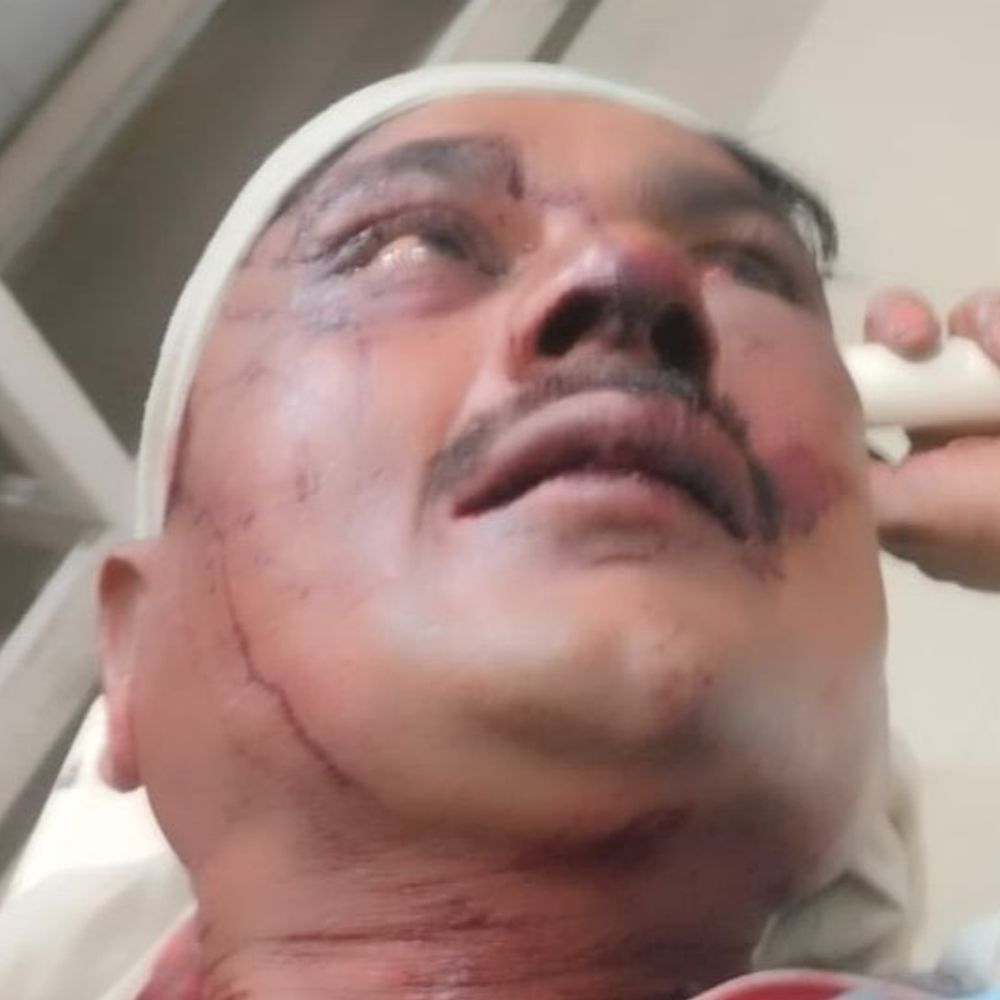 हमलावरों ने सिर फोड़ा,13 टांके आए,SHO ने टरकाया:पाकबड़ा में माली को घर में घुसकर हमलावरों ने बेहरमी से पीटा