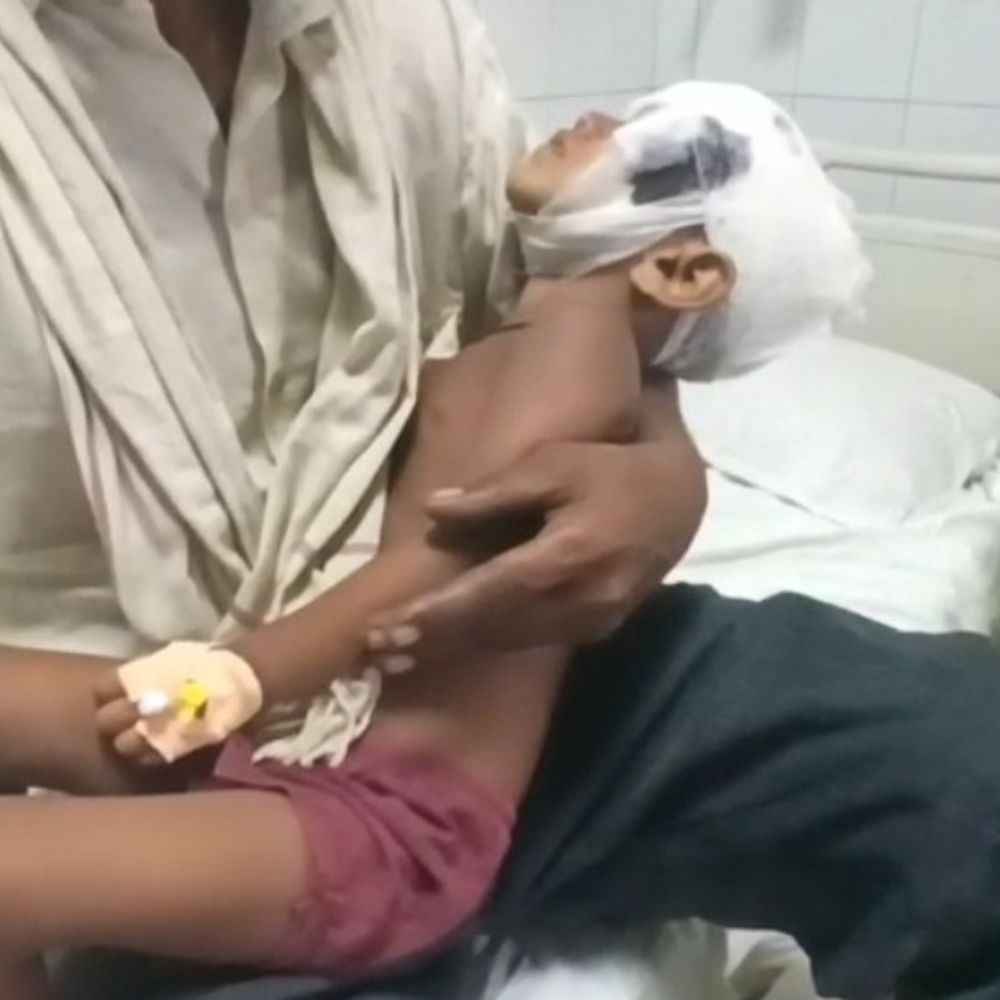 मासूम बच्ची पर पागल कुत्ते का हमला:परिजनों ने लाठी-डंडे लेकर भगाया, तब बची जान; हालत गंभीर