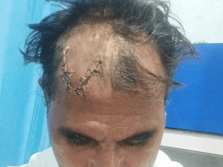 
                 हमले के पीड़ित ने सीहोर एसपी से लगाई गुहार:फ्रैक्चर के बावजूद सामान्य धाराएं लगाने का आरोप 
            