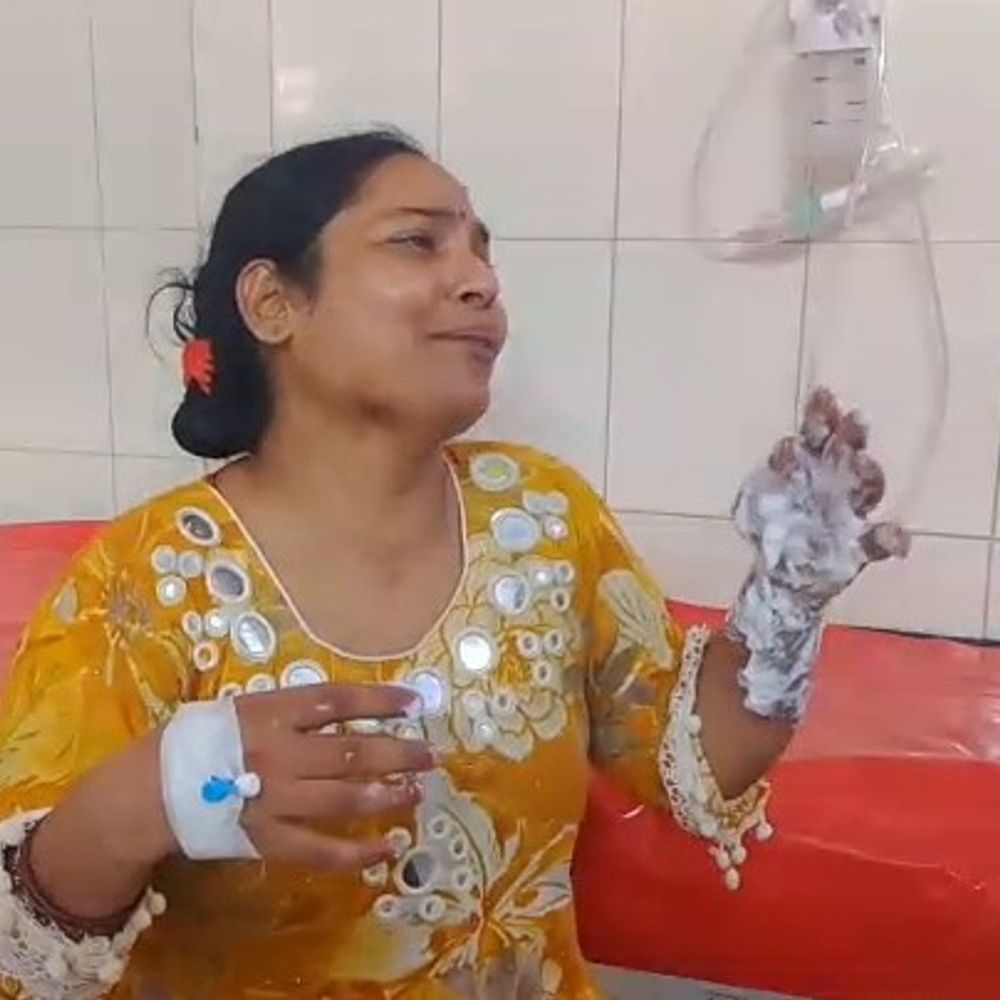 पति ने खुद को आग लगाई, पत्नी बचाने में झुलसी:उन्नाव में जमीन रजिस्ट्री विवाद के दौरान आत्महत्या करने की कोशिश, 40% जला