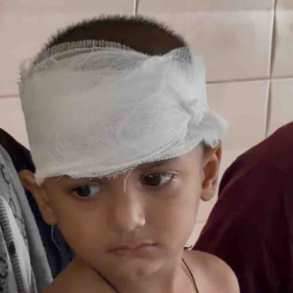 कुत्तों ने 9 घंटे में 3 मासूमों को काटा:रामपुर में सिर, कान और कमर पर काटा; मोहल्ले में दहशत