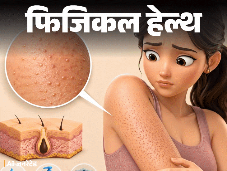 
                 फिजिकल हेल्थ- बांहों पर रेत जैसे बारीक खुरदरे दाने:ये ‘चिकन स्किन’ हो सकती है, डॉक्टर से समझें इसका कारण, इलाज और बचाव के टिप्स 
            
