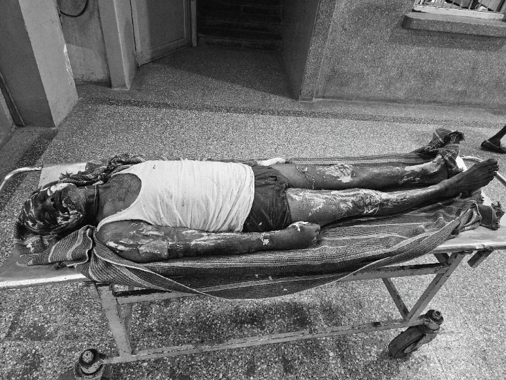 
                 मंदसौर में गैस नली लीक होने से भड़की आग:40 फीसदी झुलसे 60 वर्षीय बुजुर्ग, जिला अस्पताल में उपचार जारी 
            